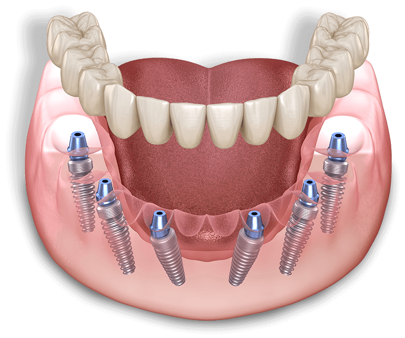 full arch graphical illustration