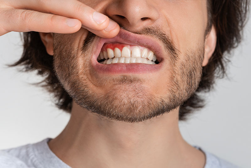 Gum disease