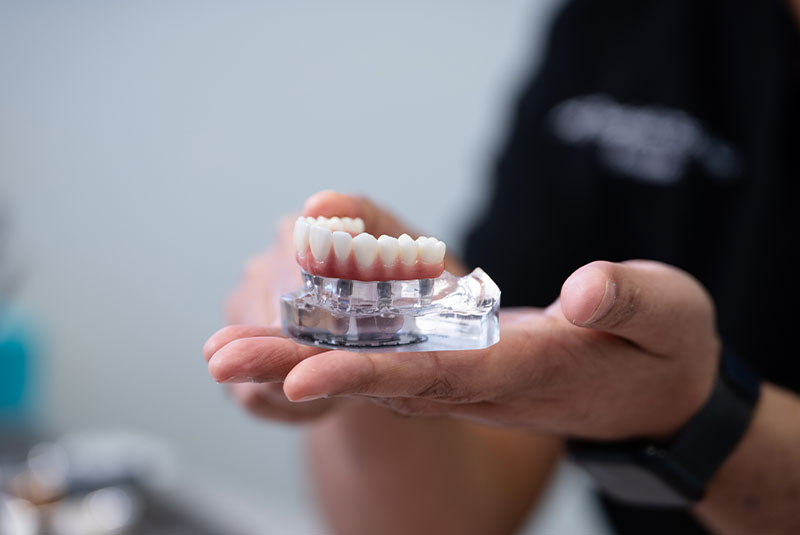model of full mouth implants
