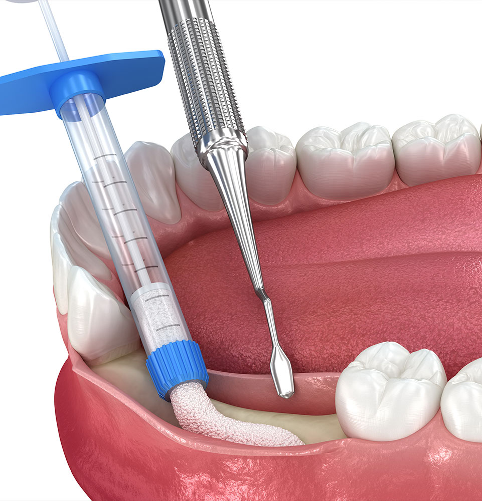 Bone grafting, augmentation. Medically accurate 3D illustration.