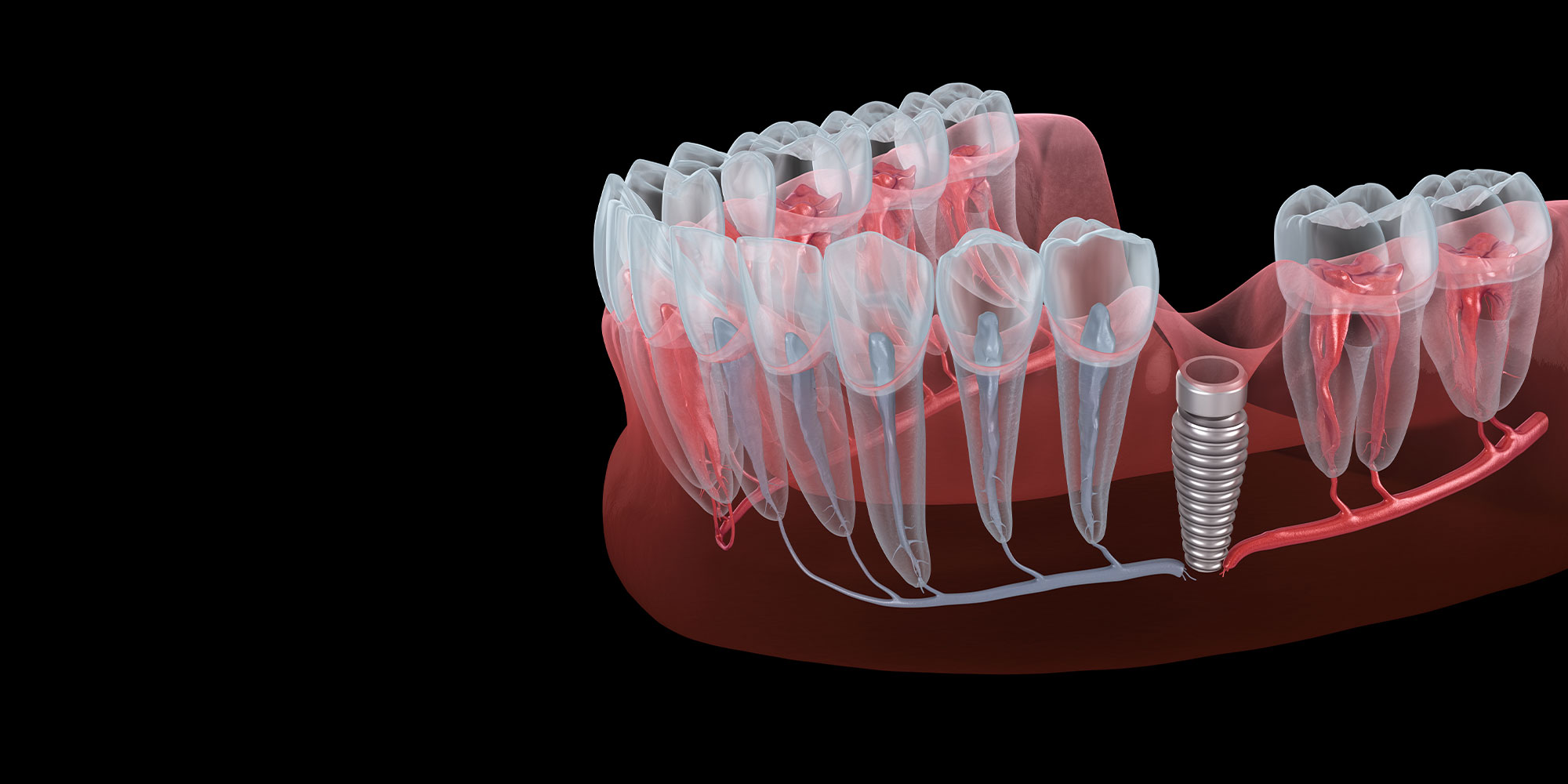 Result of unsuccessful dental implantation - nerve break. Medically accurate dental 3D illustration
