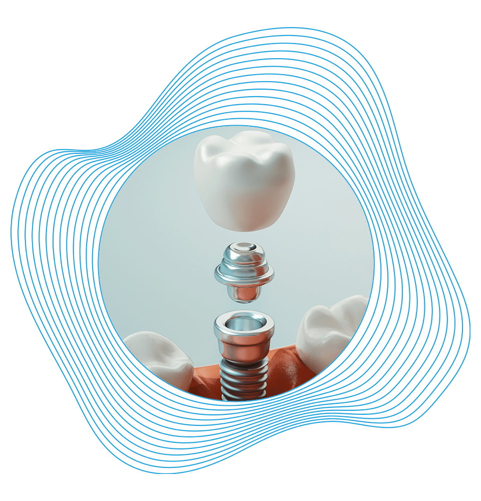 close up of dental implant illustration